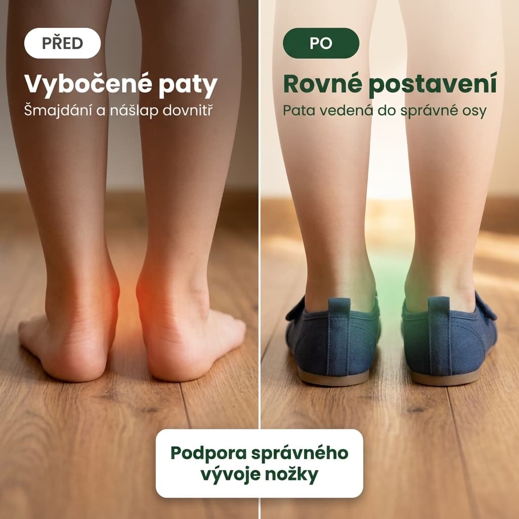 Dětské ortopedické vložky s mediálním klínem – vybočené paty před a po